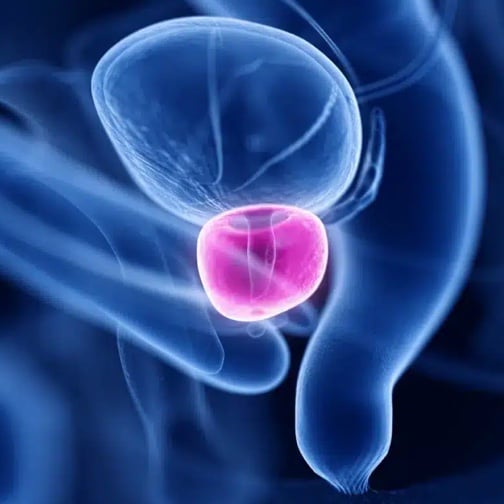 Could Focal Therapy Be an Option?