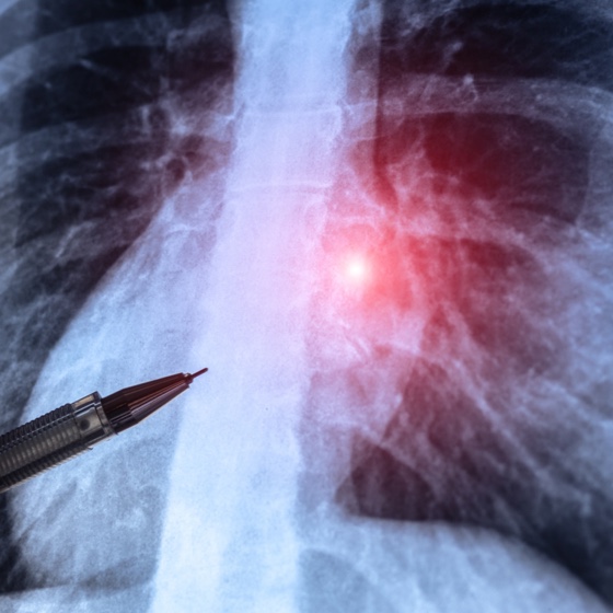 Spread to the liver and lungs