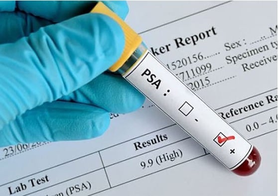 PSA blood test for prostate cancer screening