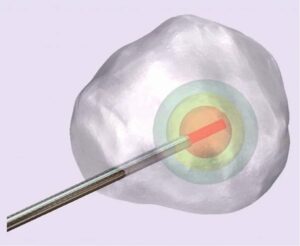 prostate biopsy diagram