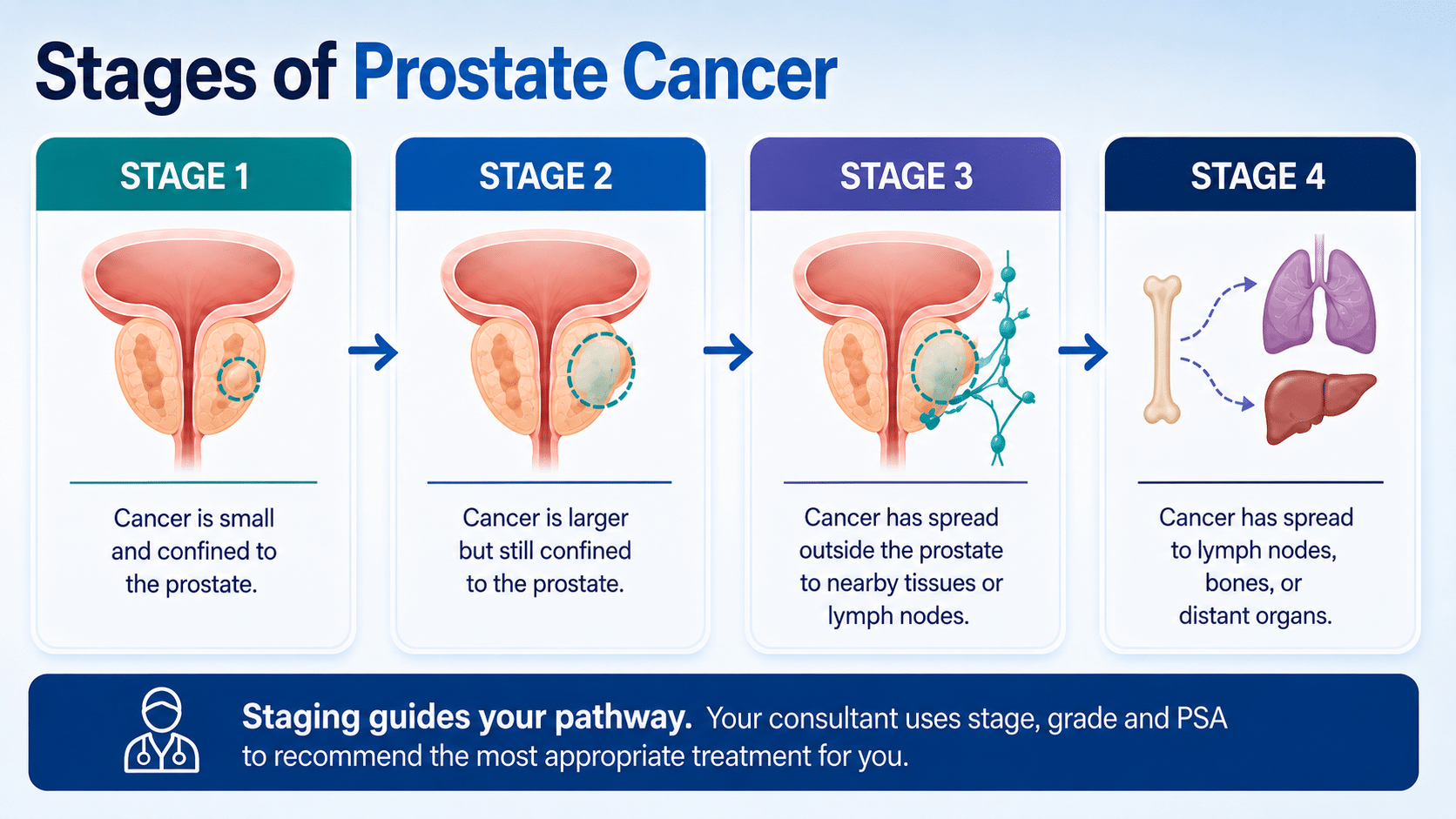 Stages of Prostate Cancer Explained