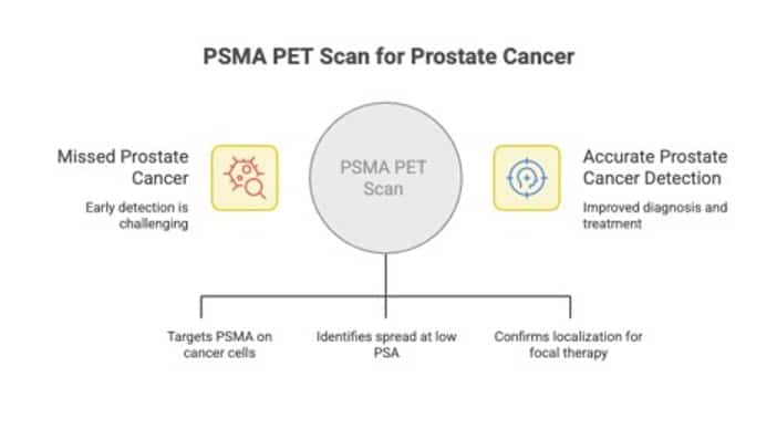 PSMA PET scan for Prostate Cancer