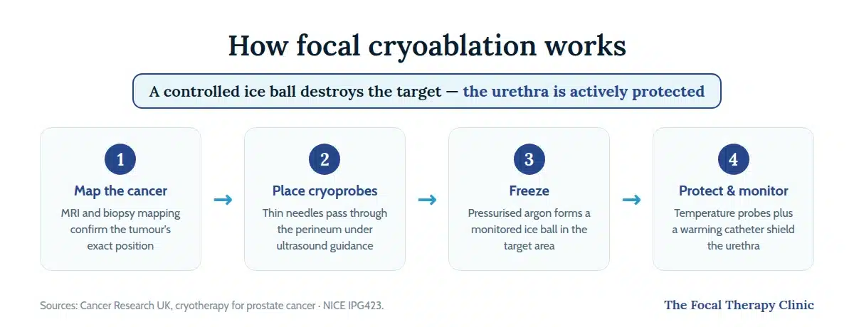 Four steps of focal cryoablation: map the cancer with MRI and biopsy, place cryoprobes through the perineum, freeze with a monitored argon ice ball, protect the urethra with a warming catheter