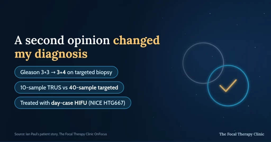 A second opinion changed my diagnosis: Gleason 3+3 became 3+4 on a 40-sample targeted biopsy after a 10-sample TRUS biopsy under-staged it, treated with day-case HIFU under NICE HTG667