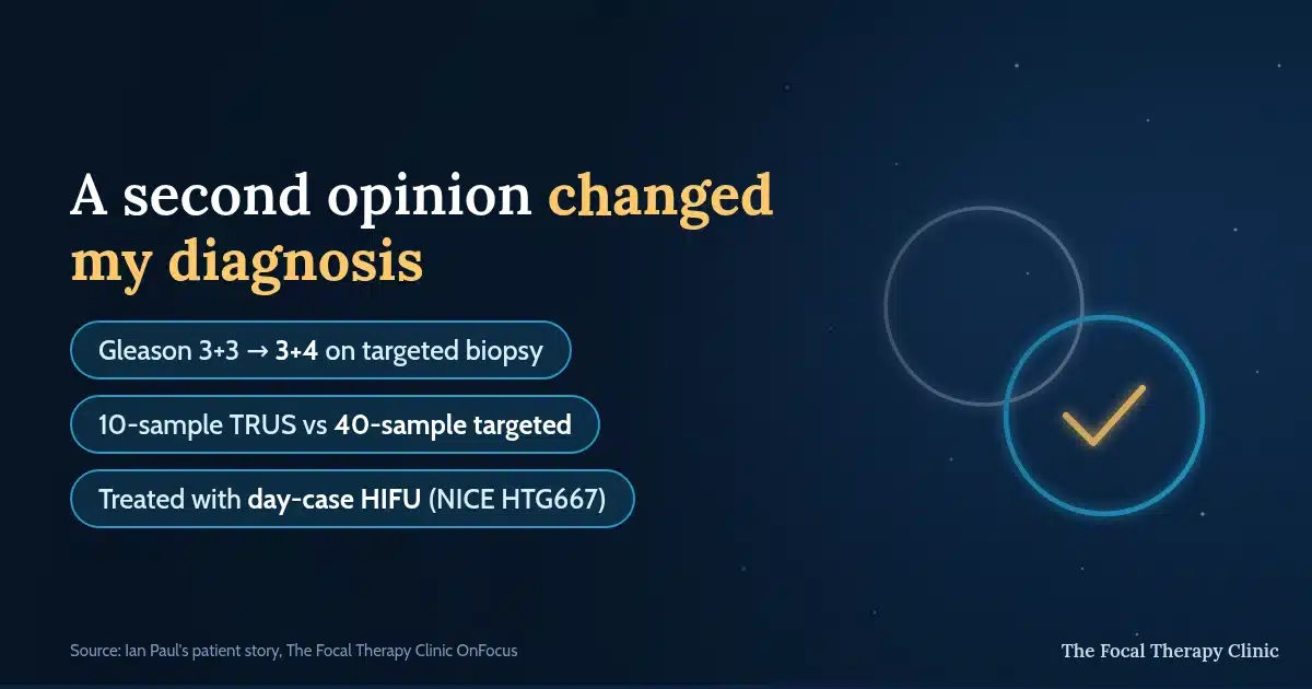 A second opinion changed my diagnosis: Gleason 3+3 became 3+4 on a 40-sample targeted biopsy after a 10-sample TRUS biopsy under-staged it, treated with day-case HIFU under NICE HTG667