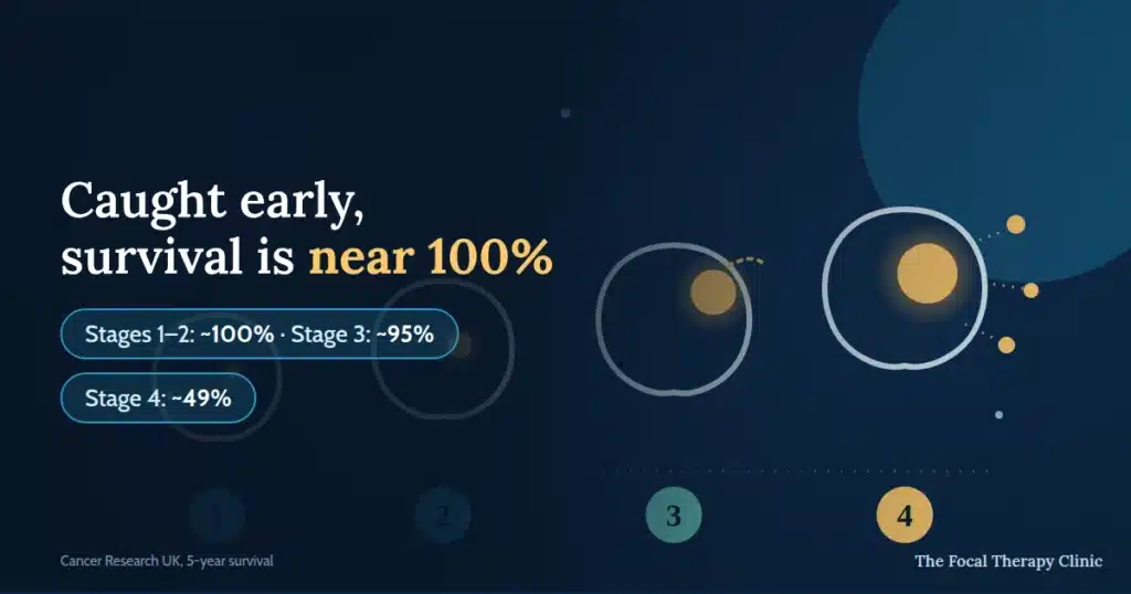 Caught early, survival is near 100% — stages 1–2 about 100%, stage 3 about 95%, stage 4 about 49%