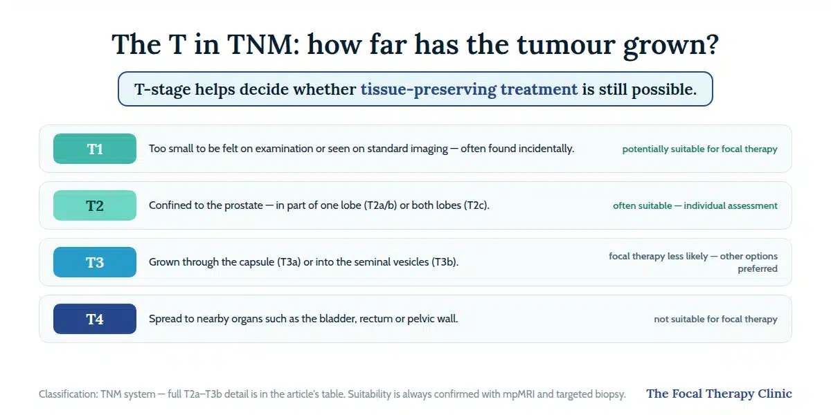 TNM T-stage guide from T1 to T4 with focal therapy suitability for each stage