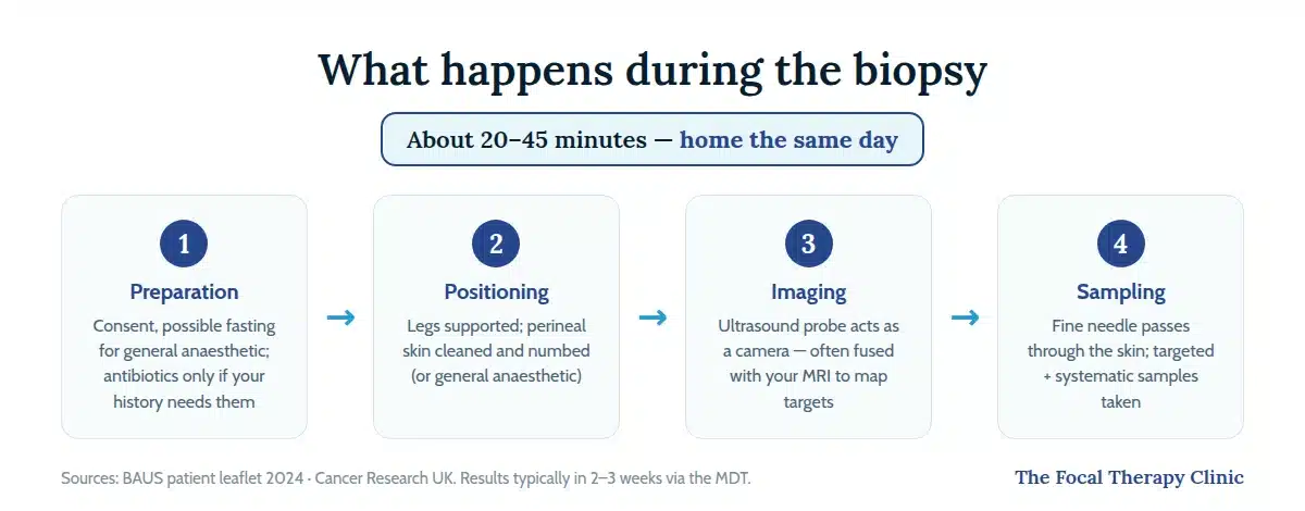 Four steps of a transperineal biopsy: preparation, positioning with perineal anaesthetic, ultrasound imaging often fused with MRI, then targeted and systematic sampling through the skin