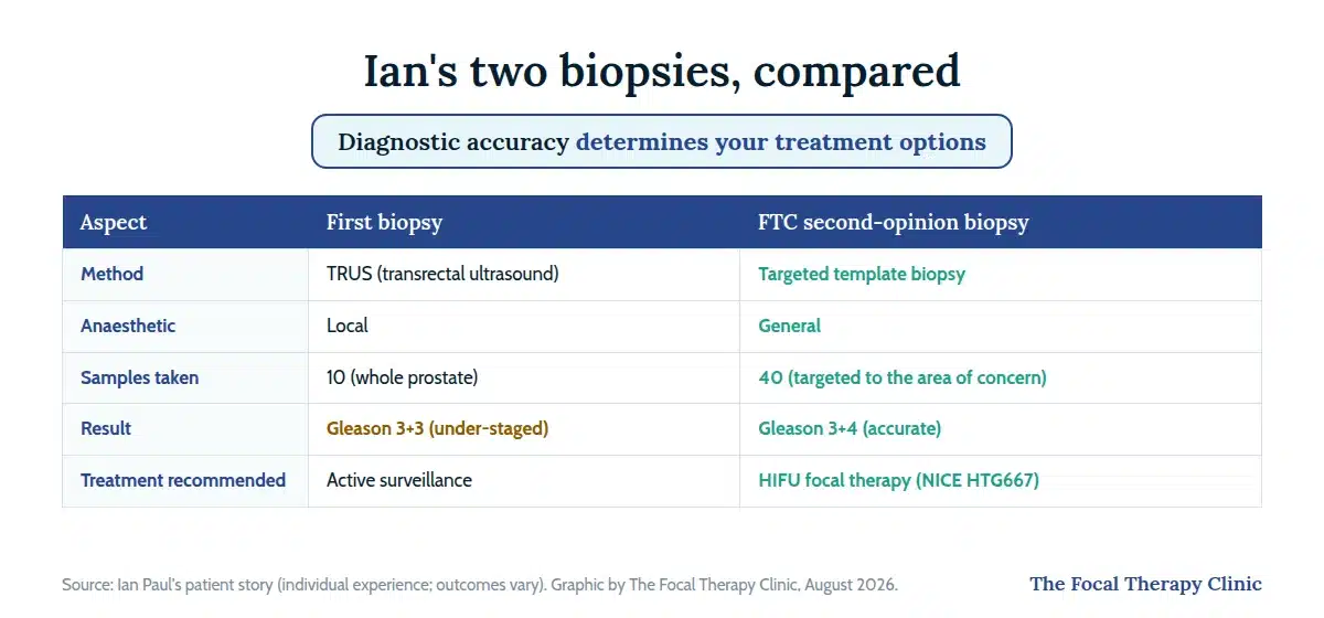 Ian's two biopsies compared: a 10-sample TRUS biopsy under local anaesthetic that under-staged his cancer as Gleason 3+3, versus a 40-sample targeted template biopsy under general anaesthetic that found Gleason 3+4 and led to HIFU focal therapy
